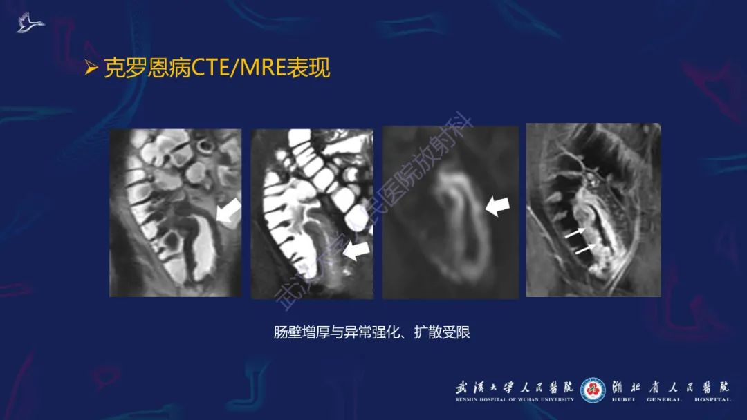 影像PPT - 【PPT】炎症性肠病影像诊断-18