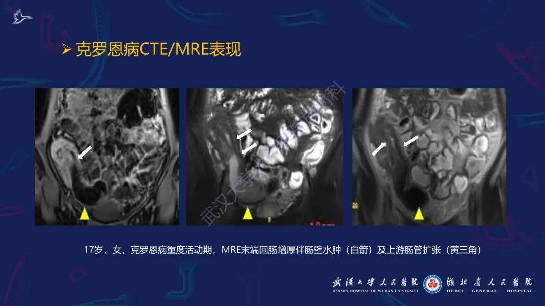 影像PPT - 【PPT】炎症性肠病影像诊断-21