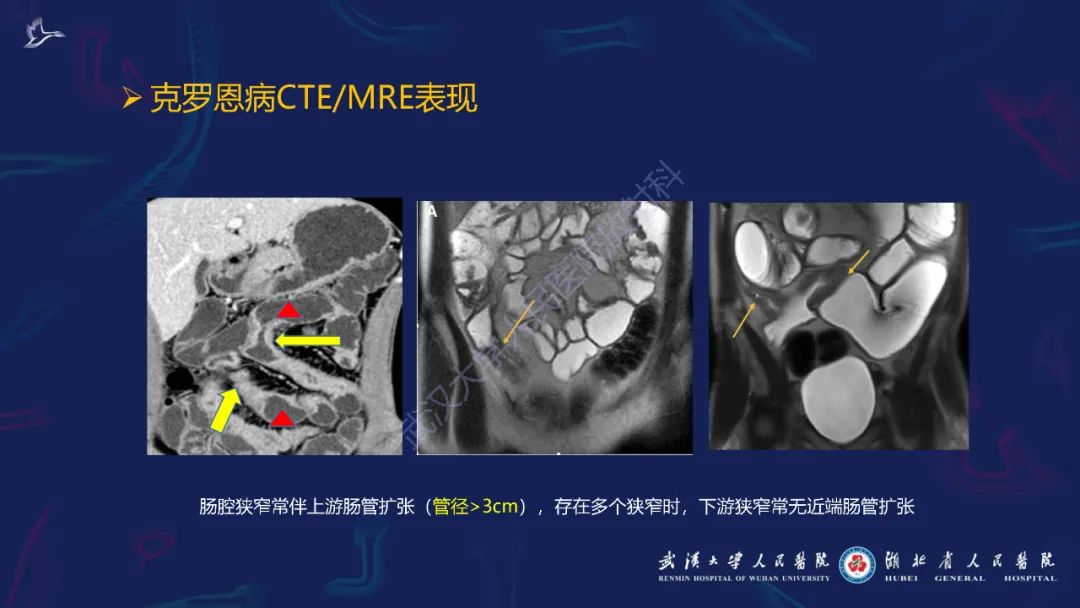 影像PPT - 【PPT】炎症性肠病影像诊断-20
