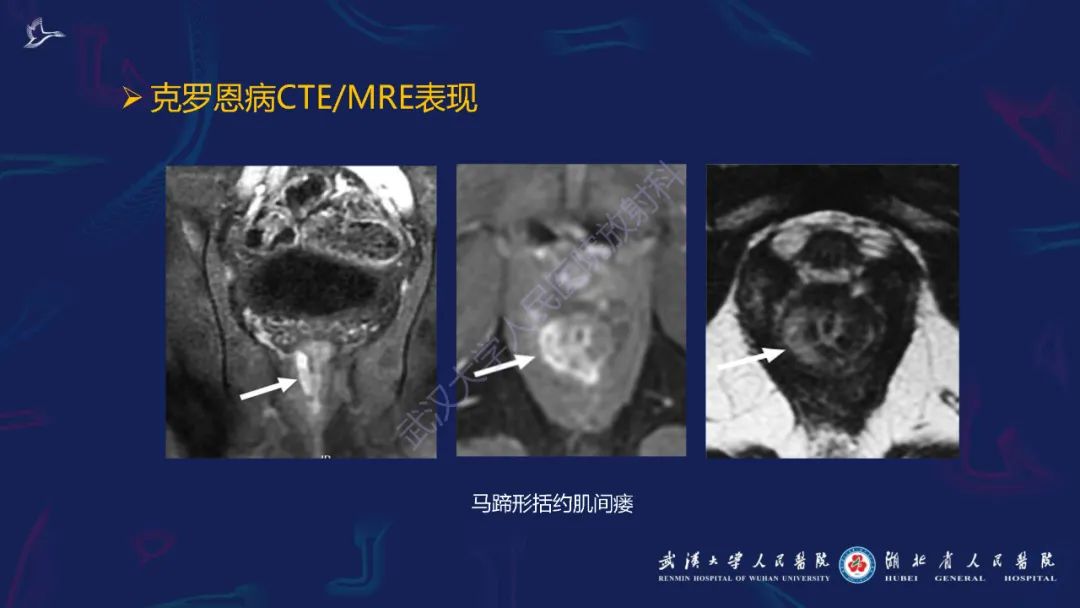 影像PPT - 【PPT】炎症性肠病影像诊断-24