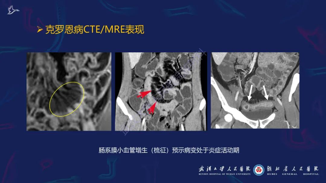 影像PPT - 【PPT】炎症性肠病影像诊断-25