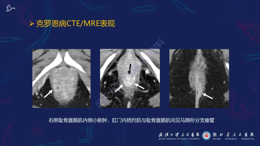 影像PPT - 【PPT】炎症性肠病影像诊断-23