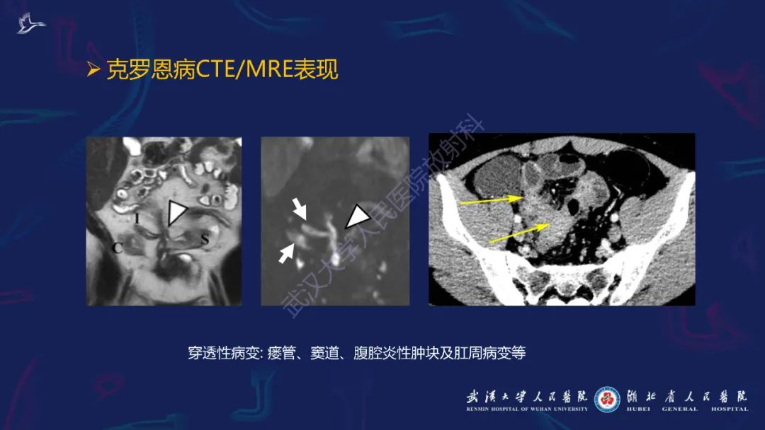 影像PPT - 【PPT】炎症性肠病影像诊断-22