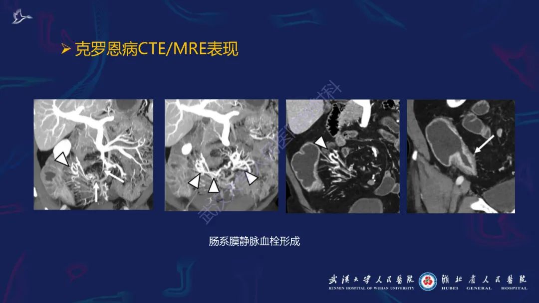 影像PPT - 【PPT】炎症性肠病影像诊断-26