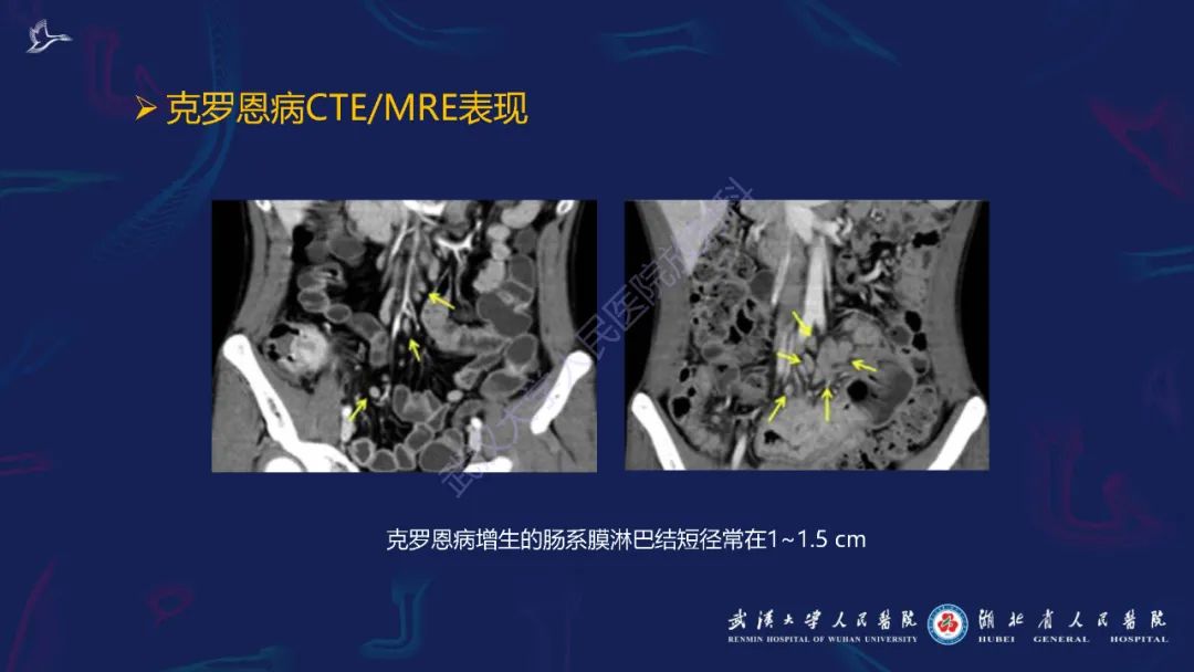 影像PPT - 【PPT】炎症性肠病影像诊断-28