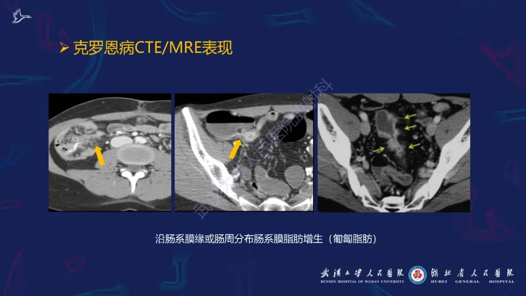 影像PPT - 【PPT】炎症性肠病影像诊断-27