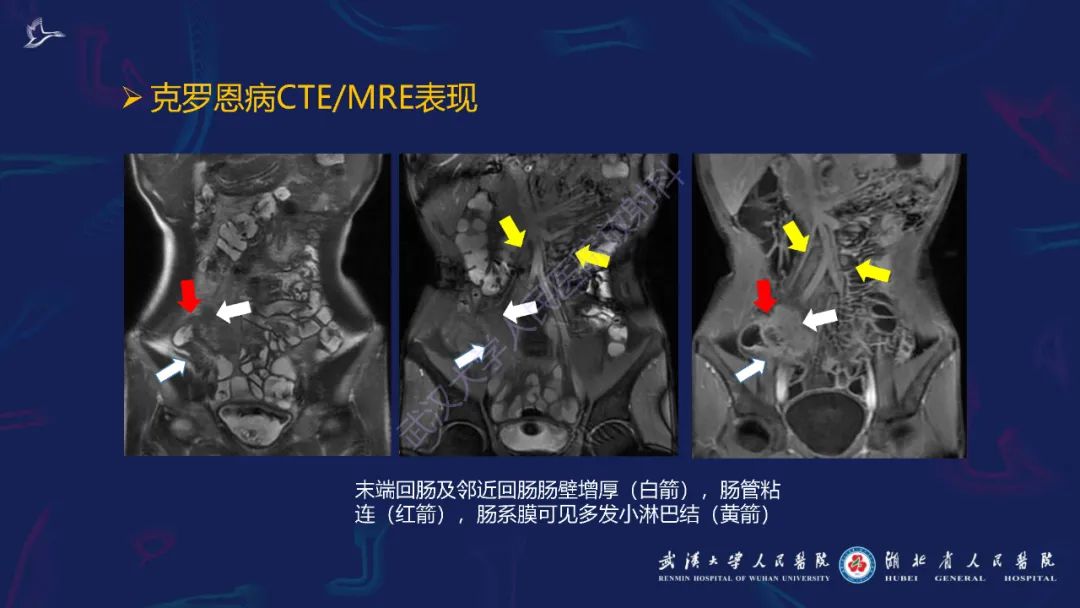 影像PPT - 【PPT】炎症性肠病影像诊断-30