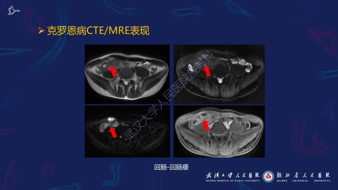 影像PPT - 【PPT】炎症性肠病影像诊断-31