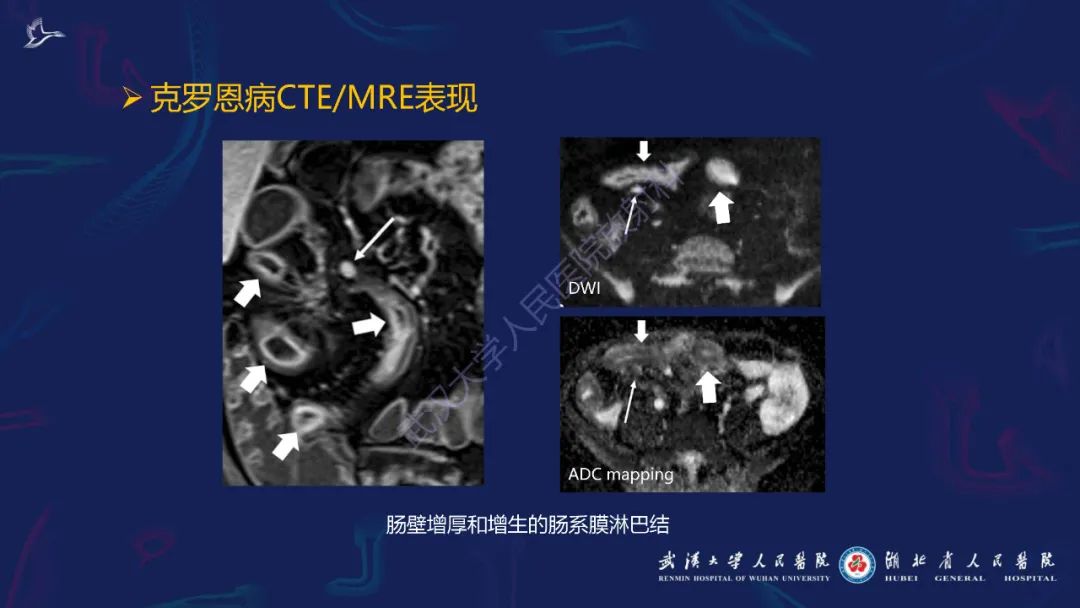 影像PPT - 【PPT】炎症性肠病影像诊断-29