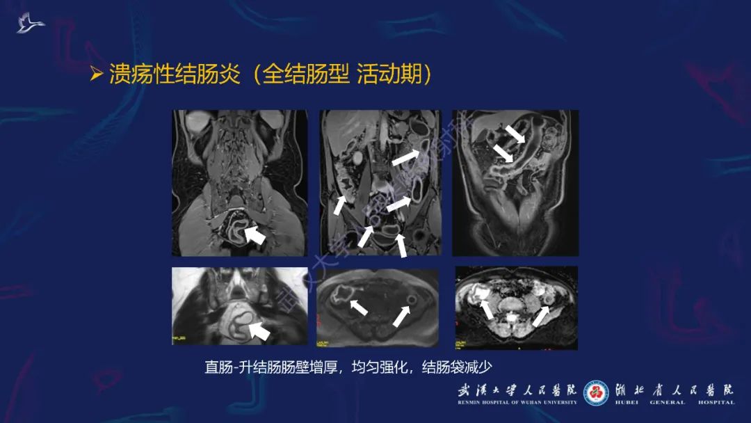 影像PPT - 【PPT】炎症性肠病影像诊断-35