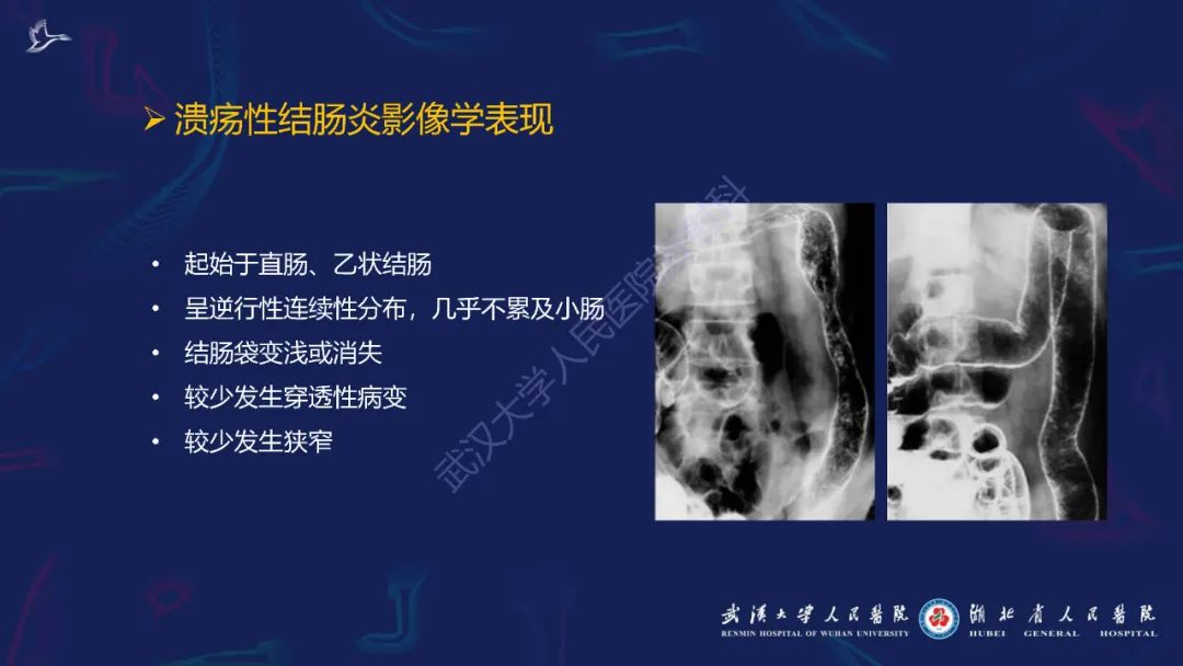 影像PPT - 【PPT】炎症性肠病影像诊断-33