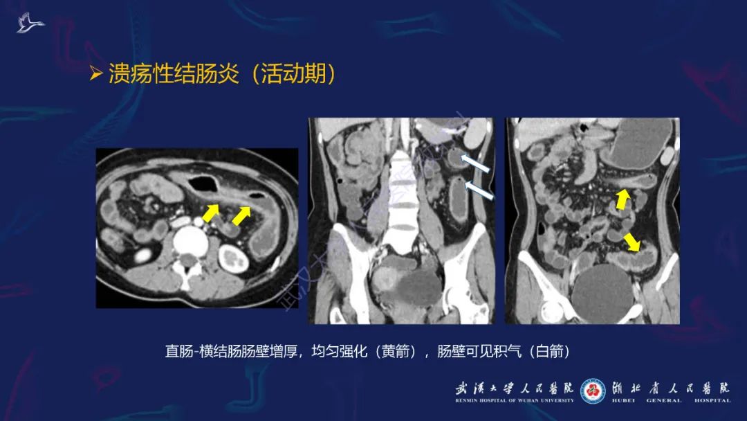 影像PPT - 【PPT】炎症性肠病影像诊断-34