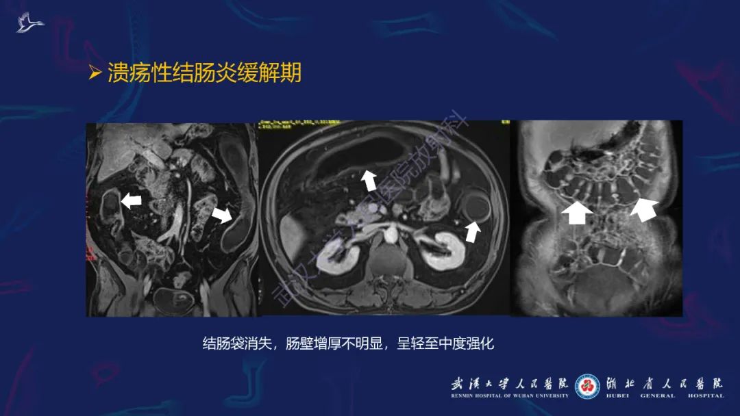 影像PPT - 【PPT】炎症性肠病影像诊断-36