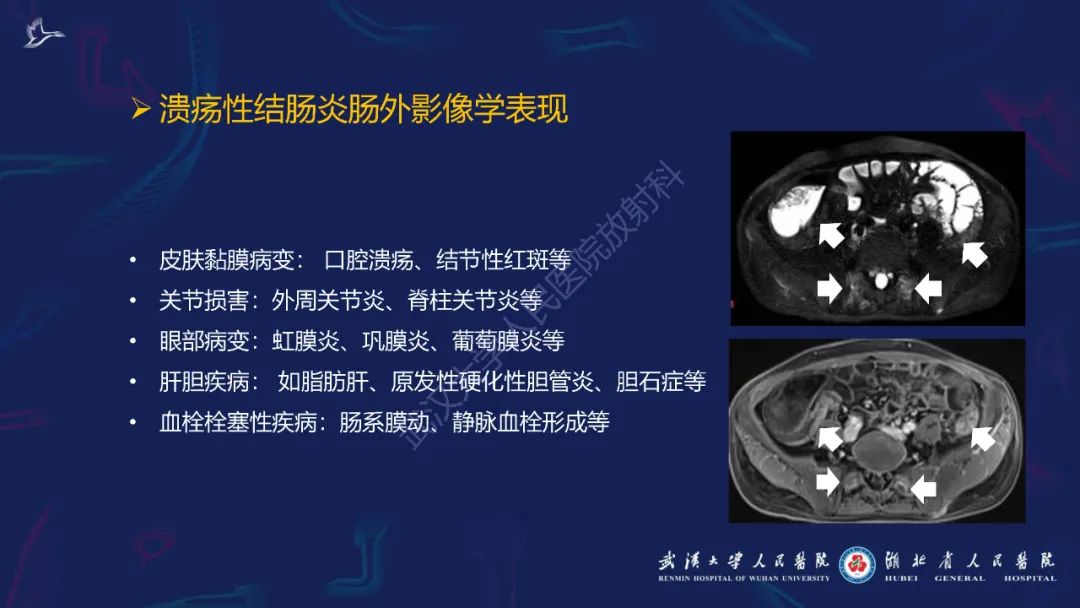 影像PPT - 【PPT】炎症性肠病影像诊断-37