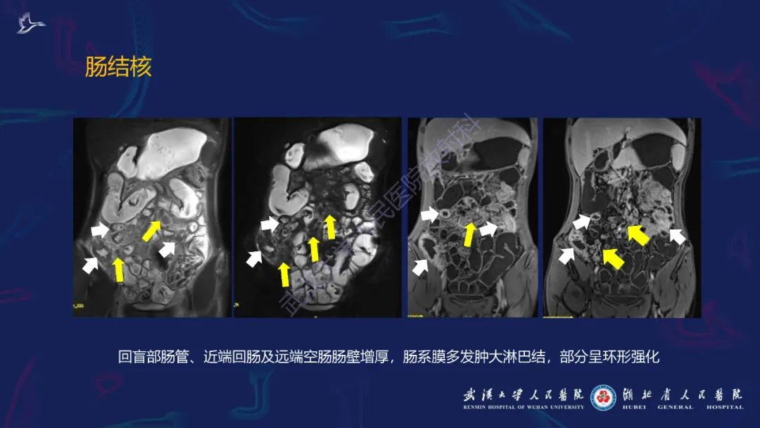 影像PPT - 【PPT】炎症性肠病影像诊断-40