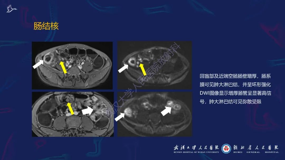 影像PPT - 【PPT】炎症性肠病影像诊断-41