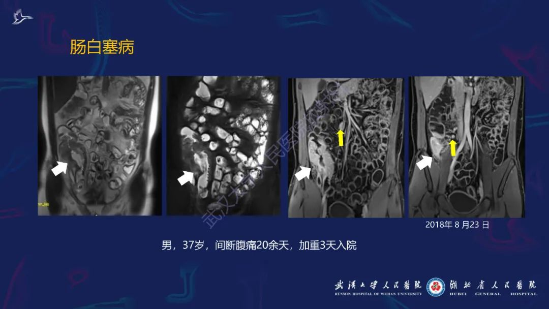 影像PPT - 【PPT】炎症性肠病影像诊断-43
