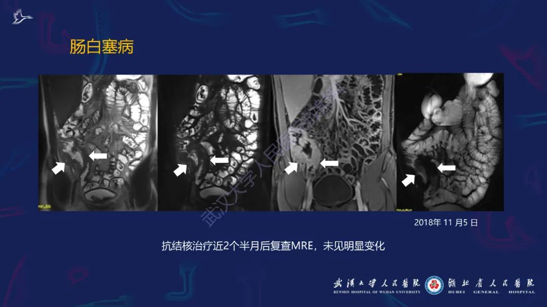 影像PPT - 【PPT】炎症性肠病影像诊断-44