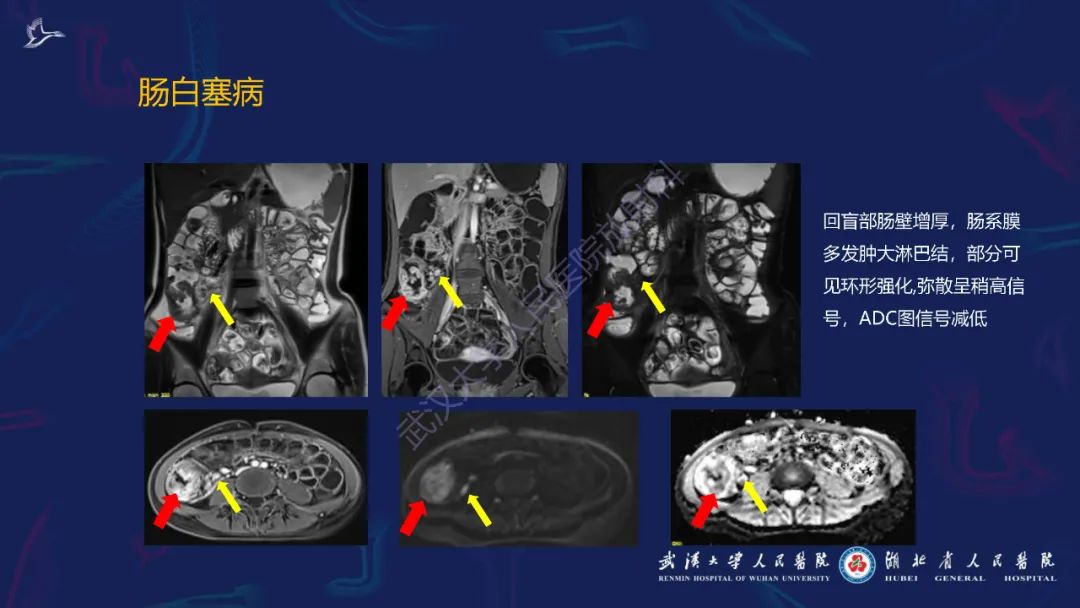 影像PPT - 【PPT】炎症性肠病影像诊断-45