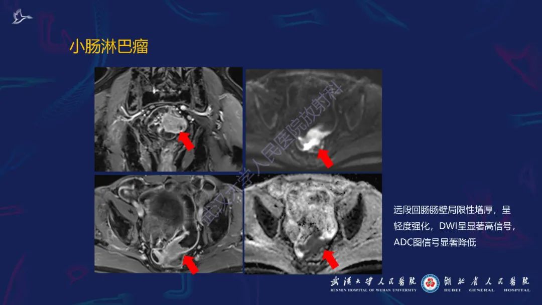 影像PPT - 【PPT】炎症性肠病影像诊断-48