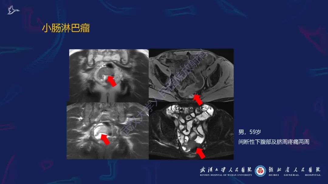 影像PPT - 【PPT】炎症性肠病影像诊断-47