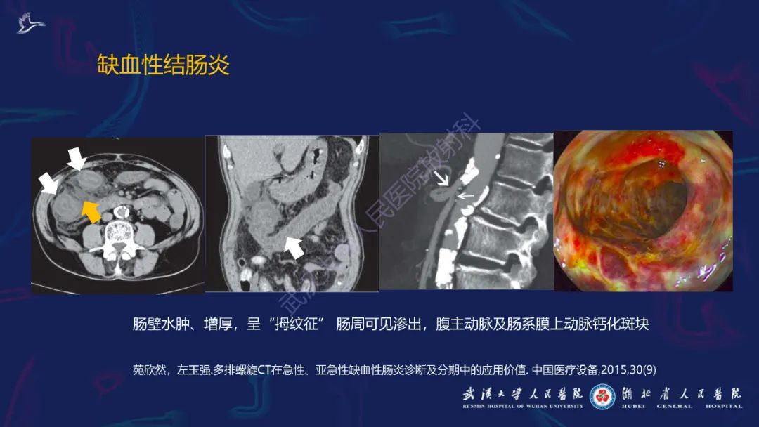 影像PPT - 【PPT】炎症性肠病影像诊断-50
