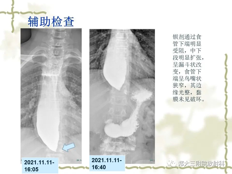 影像PPT - 【病例】贲门失弛缓症1例X线影像诊断-4