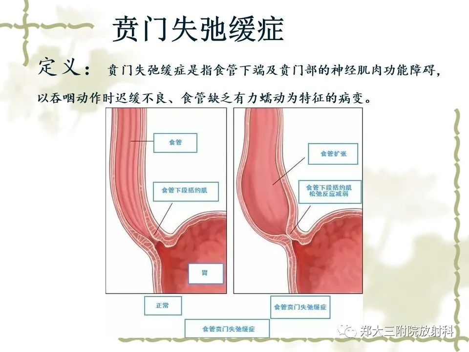 影像PPT - 【病例】贲门失弛缓症1例X线影像诊断-6