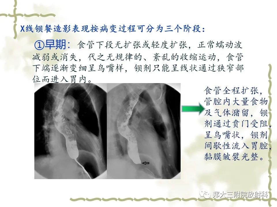 影像PPT - 【病例】贲门失弛缓症1例X线影像诊断-10