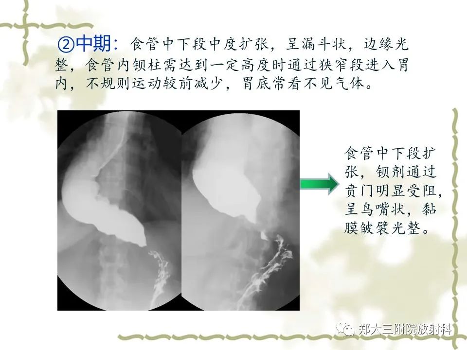 影像PPT - 【病例】贲门失弛缓症1例X线影像诊断-11