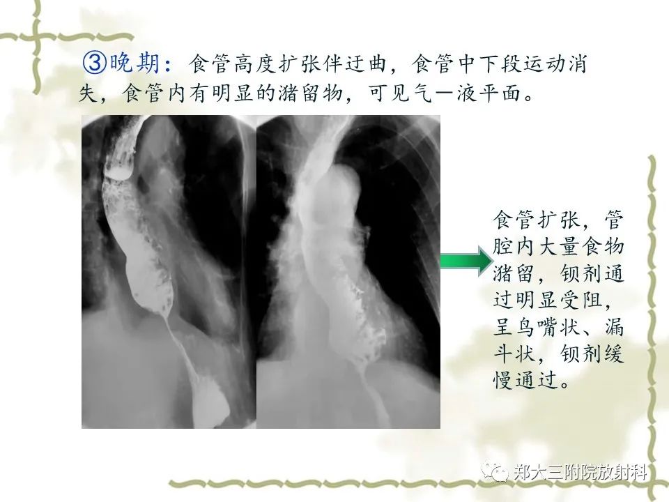 影像PPT - 【病例】贲门失弛缓症1例X线影像诊断-12