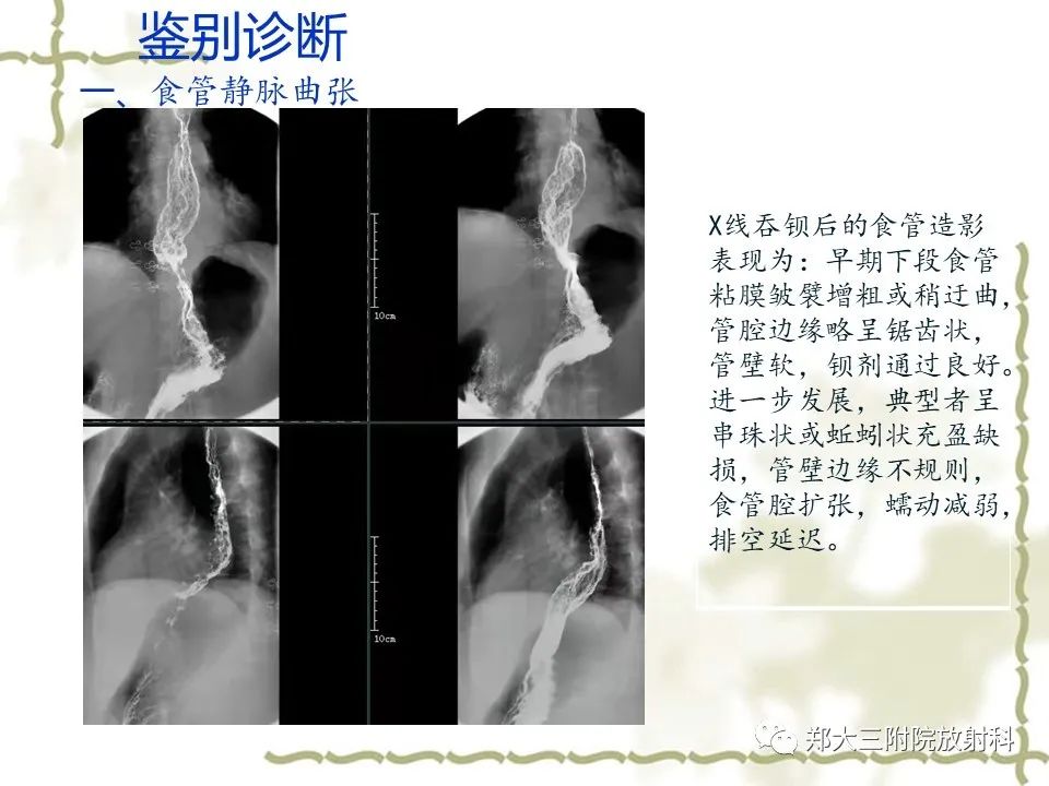 影像PPT - 【病例】贲门失弛缓症1例X线影像诊断-14