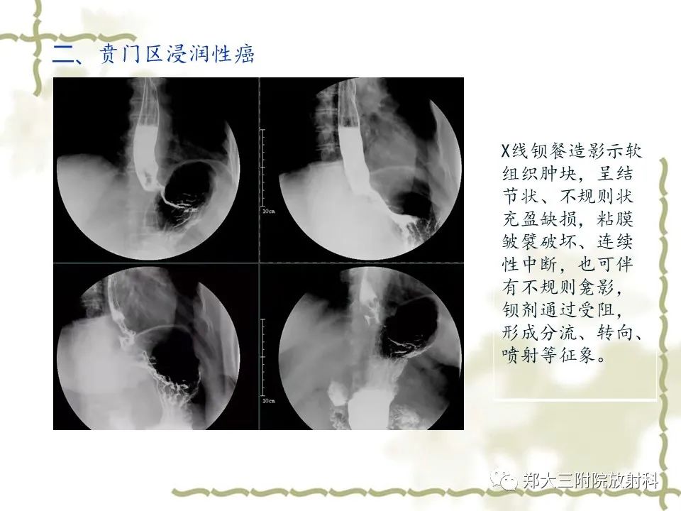 影像PPT - 【病例】贲门失弛缓症1例X线影像诊断-15