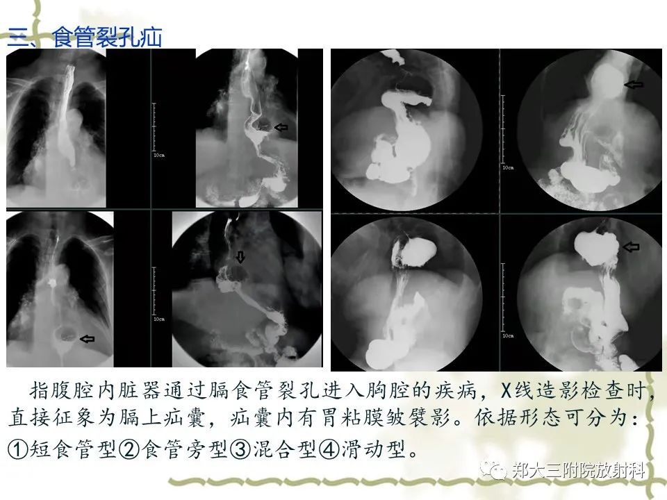 影像PPT - 【病例】贲门失弛缓症1例X线影像诊断-16