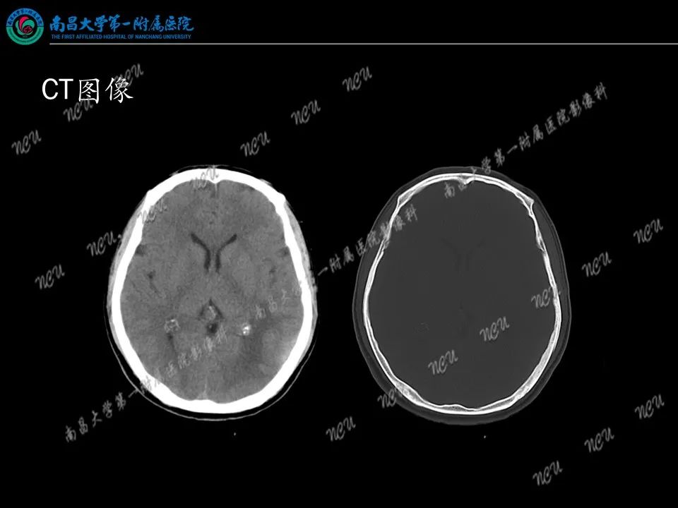 影像PPT - 【PPT】易误诊为脑膜瘤的病例分析-5