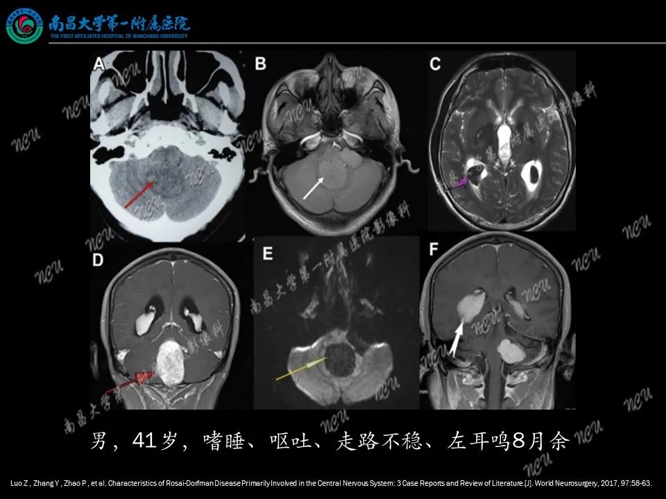 影像PPT - 【PPT】易误诊为脑膜瘤的病例分析-12