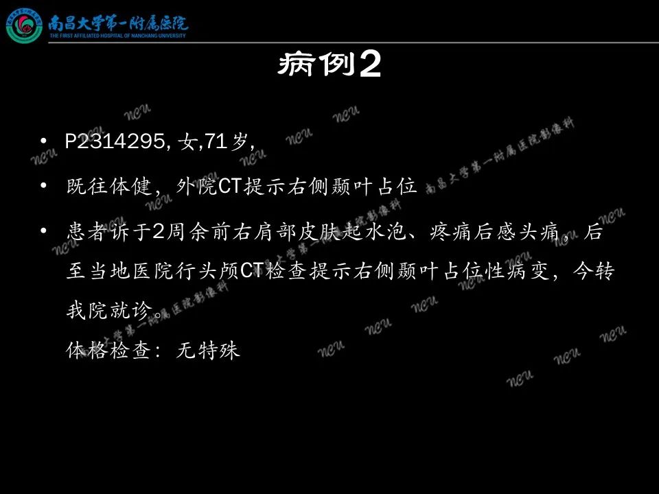 影像PPT - 【PPT】易误诊为脑膜瘤的病例分析-14
