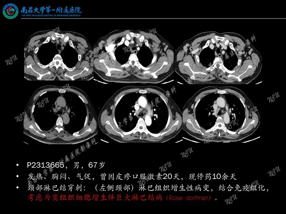影像PPT - 【PPT】易误诊为脑膜瘤的病例分析-13