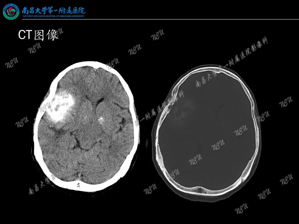 影像PPT - 【PPT】易误诊为脑膜瘤的病例分析-15