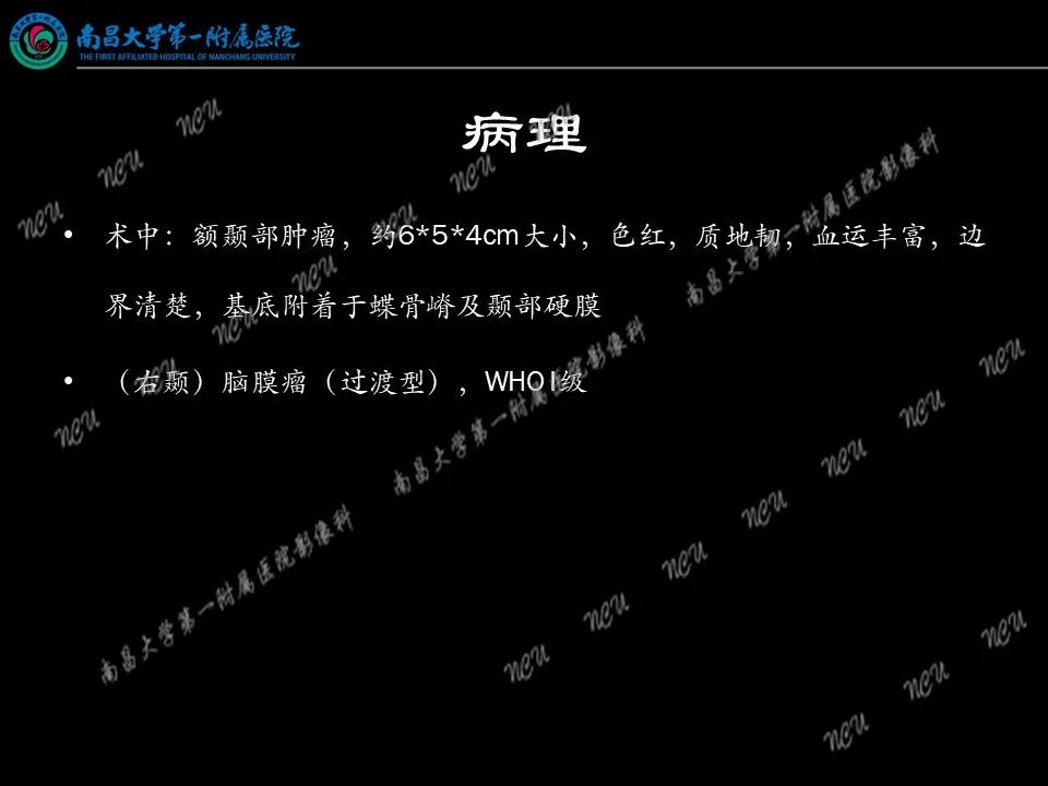 影像PPT - 【PPT】易误诊为脑膜瘤的病例分析-19