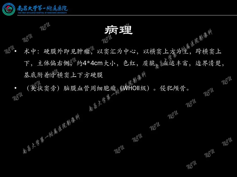 影像PPT - 【PPT】易误诊为脑膜瘤的病例分析-28