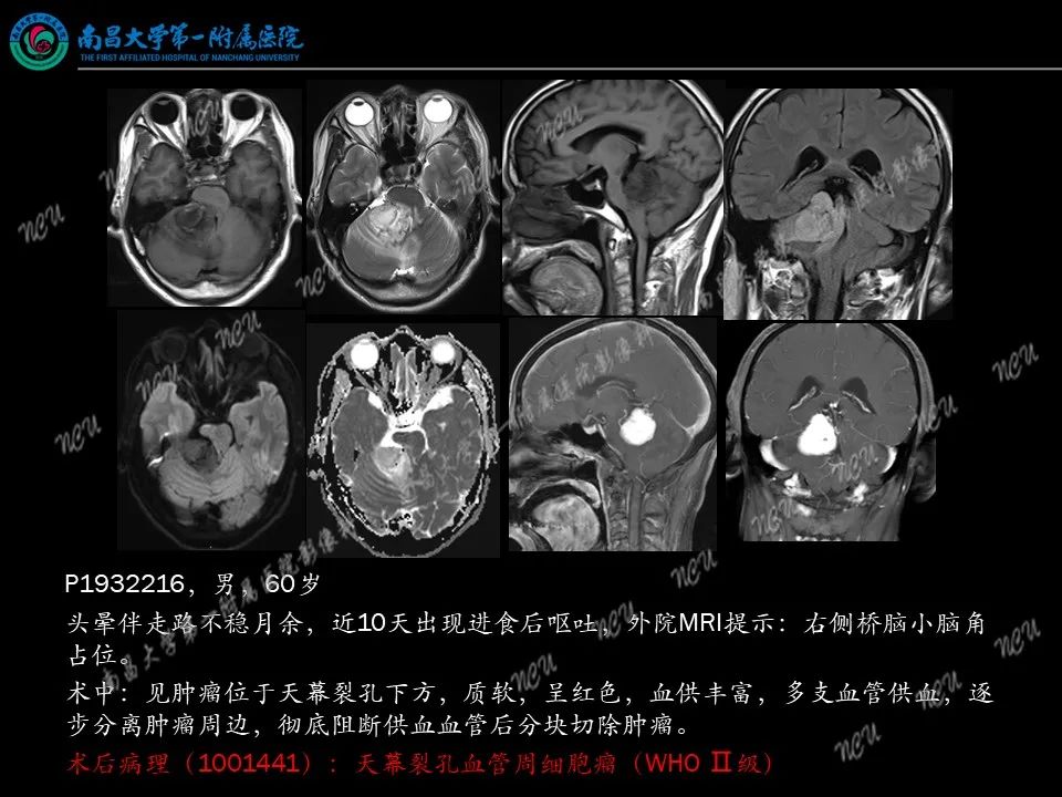 影像PPT - 【PPT】易误诊为脑膜瘤的病例分析-31