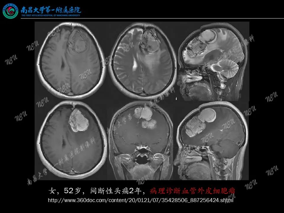 影像PPT - 【PPT】易误诊为脑膜瘤的病例分析-33