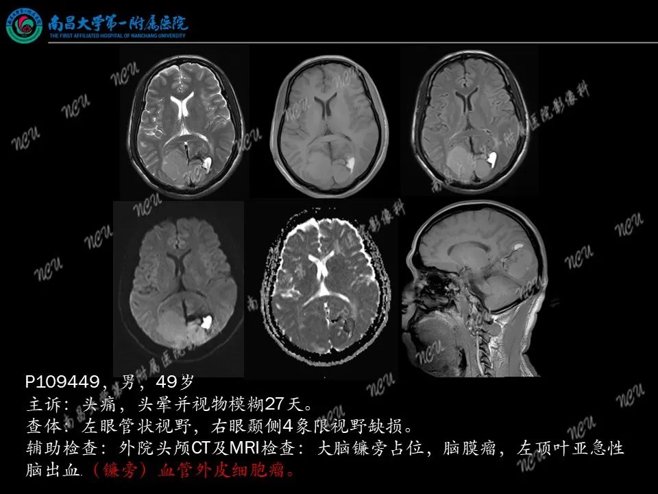 影像PPT - 【PPT】易误诊为脑膜瘤的病例分析-34