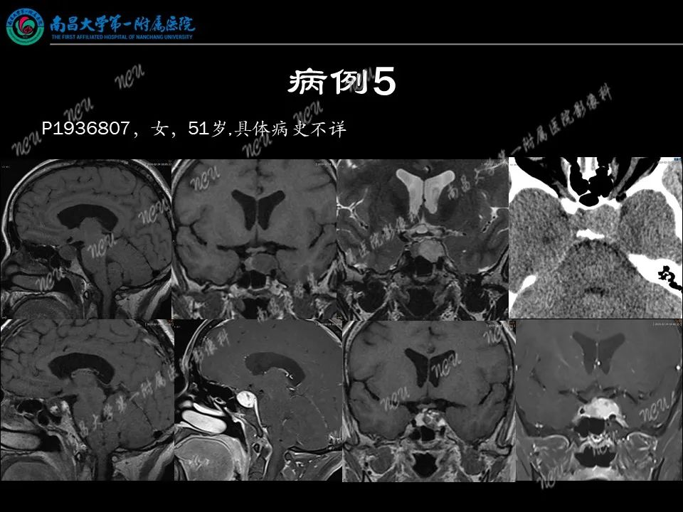 影像PPT - 【PPT】易误诊为脑膜瘤的病例分析-46