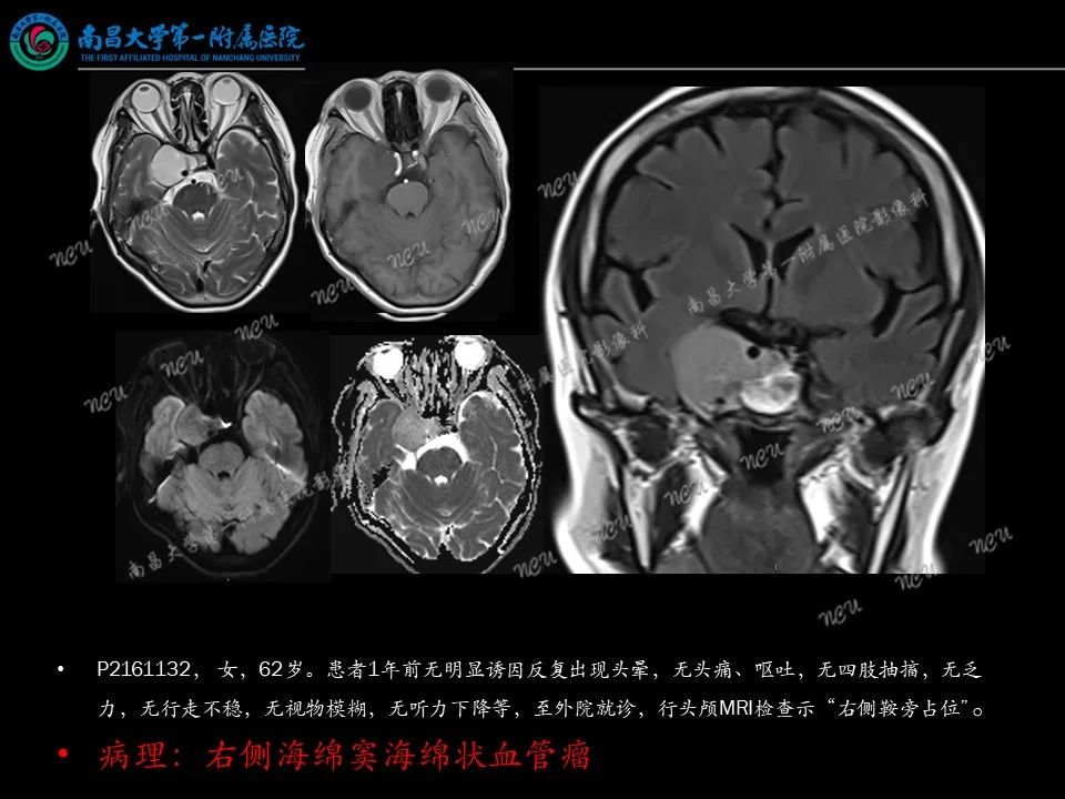 影像PPT - 【PPT】易误诊为脑膜瘤的病例分析-51