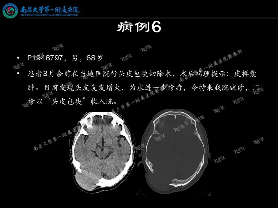 影像PPT - 【PPT】易误诊为脑膜瘤的病例分析-53