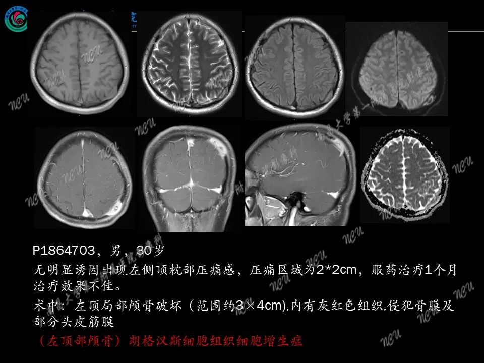 影像PPT - 【PPT】易误诊为脑膜瘤的病例分析-68
