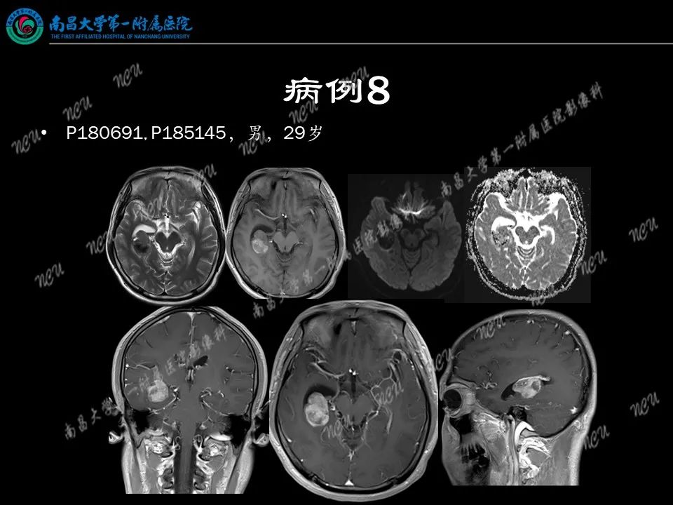 影像PPT - 【PPT】易误诊为脑膜瘤的病例分析-70