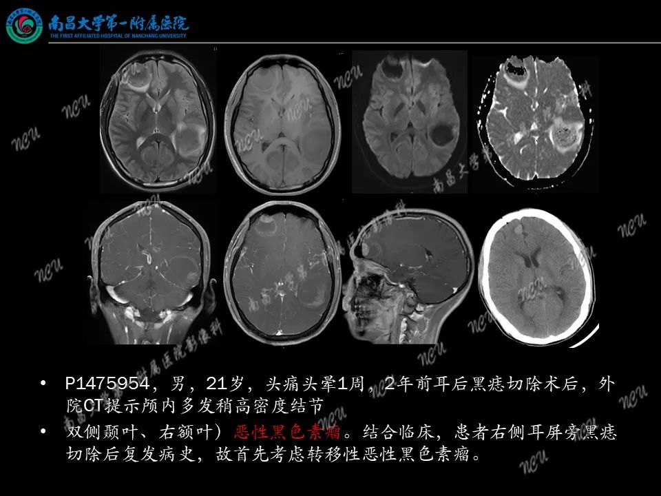 影像PPT - 【PPT】易误诊为脑膜瘤的病例分析-75